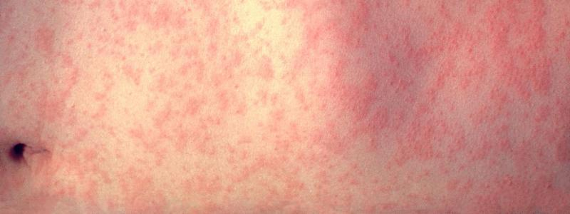 Interna ve Svitavské nemocnici dočasně upravila provoz kvůli spalničkám