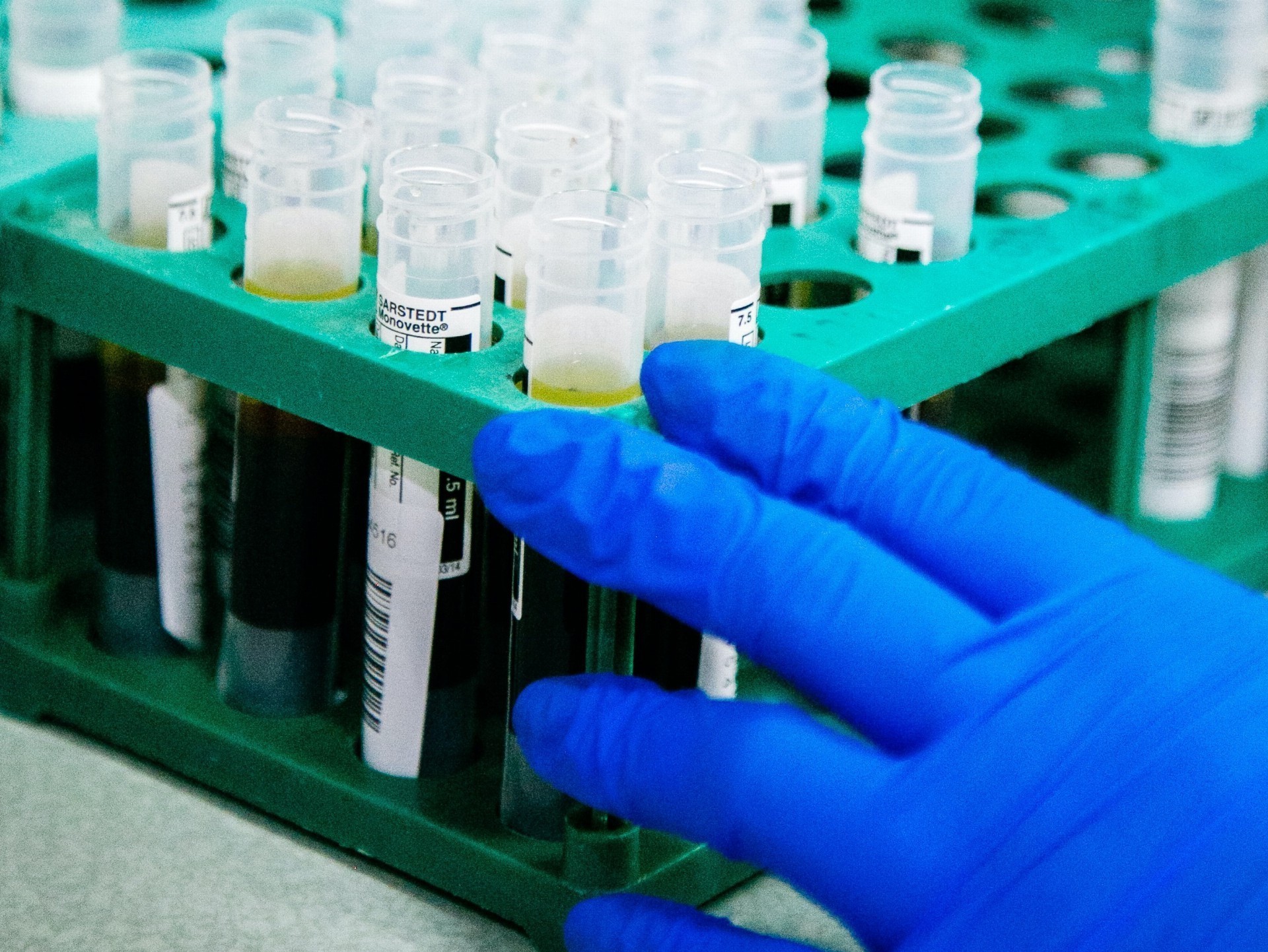 Aktualita OKBD OUN – NT-proBNP